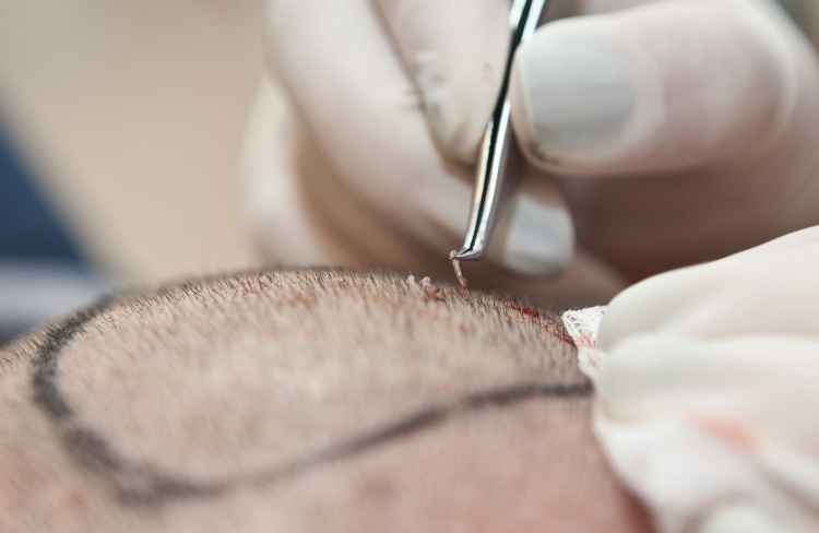 DHI vs FUE: Understanding the Pros and Cons of Hair Transplant Procedures 2 hair transplant operation 2