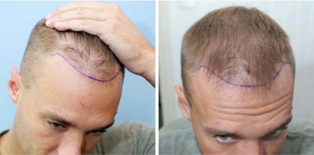 The Rise of Hair Transplants: Calum Best's Experience Sheds Light on a Growing Trend 1 Calum Best hair Transplantation 1