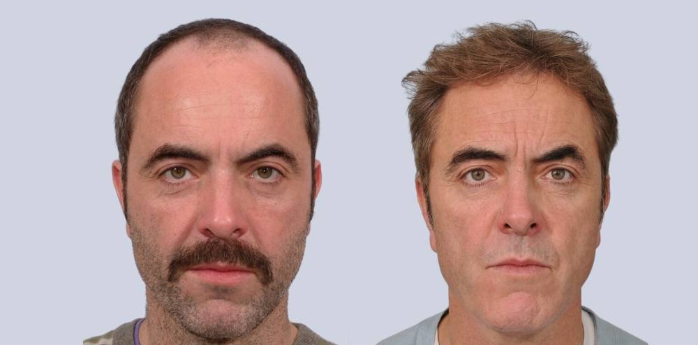 james nesbitt hair transplant