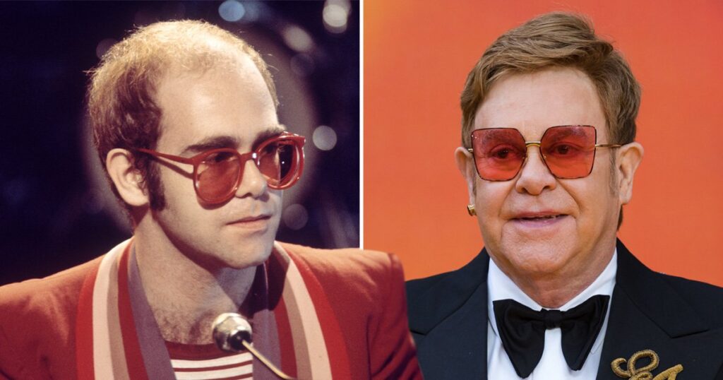 Elton John's Hair Transplant: A Look At The Procedure, Results, And Its 