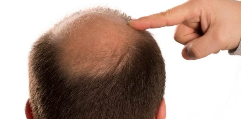 Identifying the Different Hair Loss Factors and How to Address Them ...